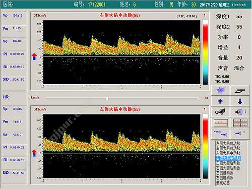 科进 Kejin 超声经颅多普勒血流分析仪 KJ-2V7M 经颅多普勒