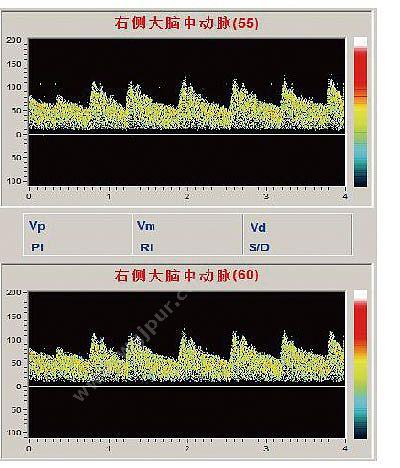 科进 Kejin 超声经颅多普勒血流分析仪 KJ-2V6M+ 经颅多普勒