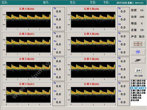 科进 Kejin 超声经颅多普勒血流分析仪 KJ-2V7M 经颅多普勒