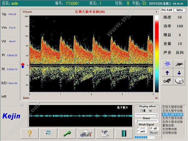 科进 Kejin 超声经颅多普勒血流分析仪 KJ-2V7M 经颅多普勒