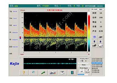 科进 Kejin 超声经颅多普勒血流分析仪 KJ-2V6M 经颅多普勒