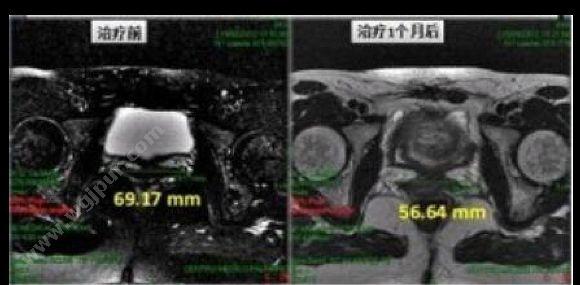 高科恒大 GKHD 二氧化碳激光治疗机 CHX-100H（私密国产玻璃管） 激光设备